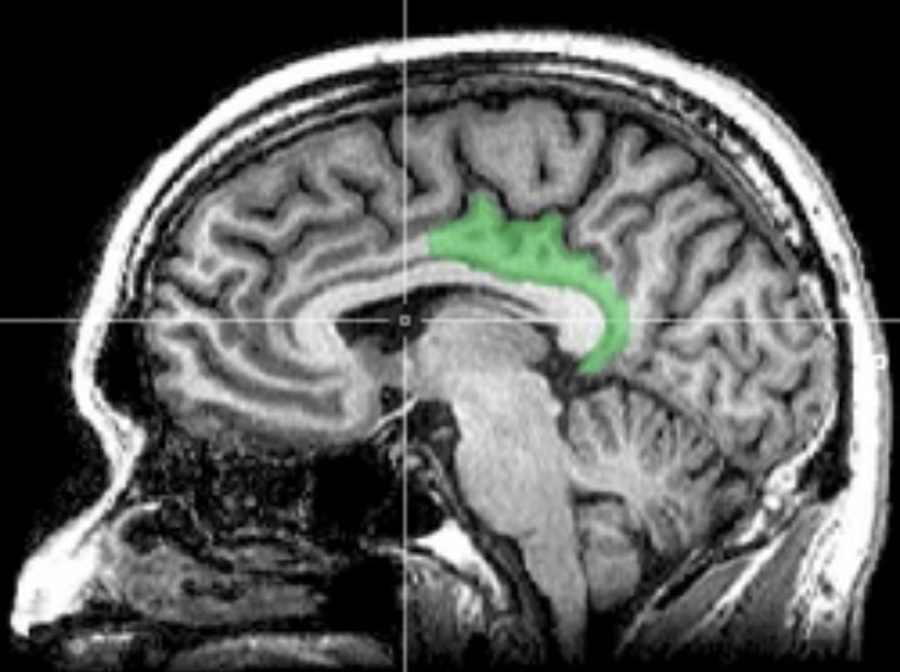 A cross-section of brain imaging.